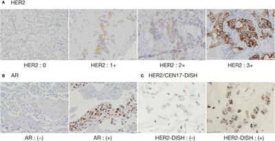 Enhanced Angiogenesis in Salivary Duct Carcinoma Ex-Pleomorphic Adenoma